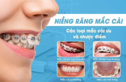 Tất Tần Tật Về Niềng Răng Mắc Cài: Ưu Điểm và Nhược Điểm Của Các Loại